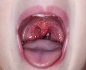 sore teeth and throat